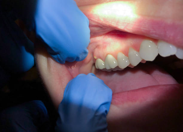Best Emergency Dentist for Lost Fillings or Crowns in Chesilhurst, NJ
